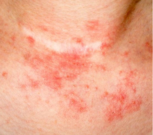 Eczema